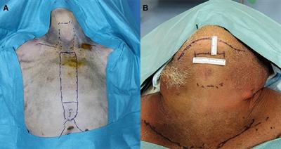 Remote-access thyroidectomy with the da Vinci SP system: feasibility in a cadaveric model